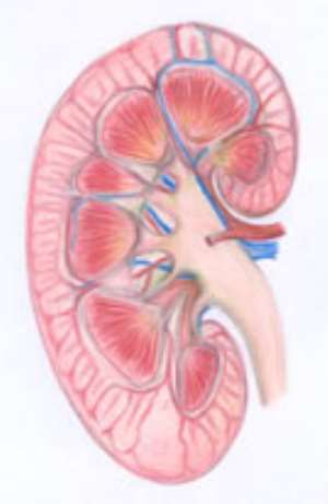 Kidney Failure -The Highest Cause Of Death In Ghana